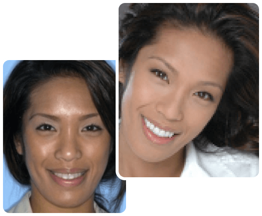 Veneers and porcelain crowns combination case