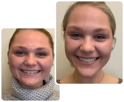 Full anterior porcelain veneers