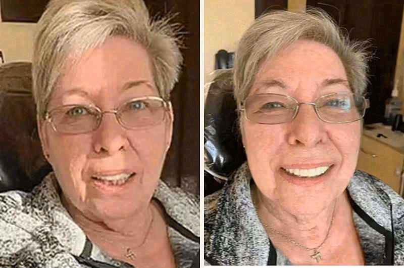 Combination implant and cosmetic restoration case