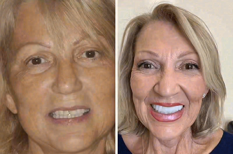 Jeffrey, implants and veneers patient at Sola Dental Spa