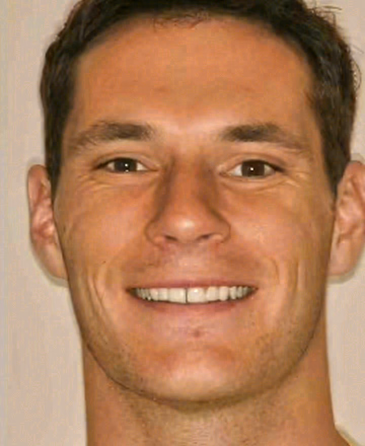 After porcelain veneers at Sola Dental Spa