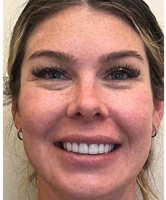 Porcelain veneers smile, Sola Dental Spa