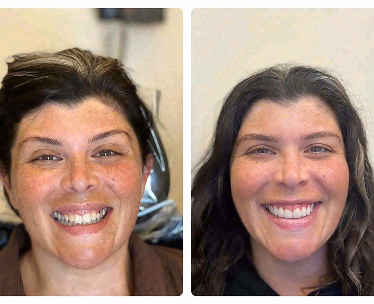 Patient relaxed under the Philips Zoom whitening lamp
