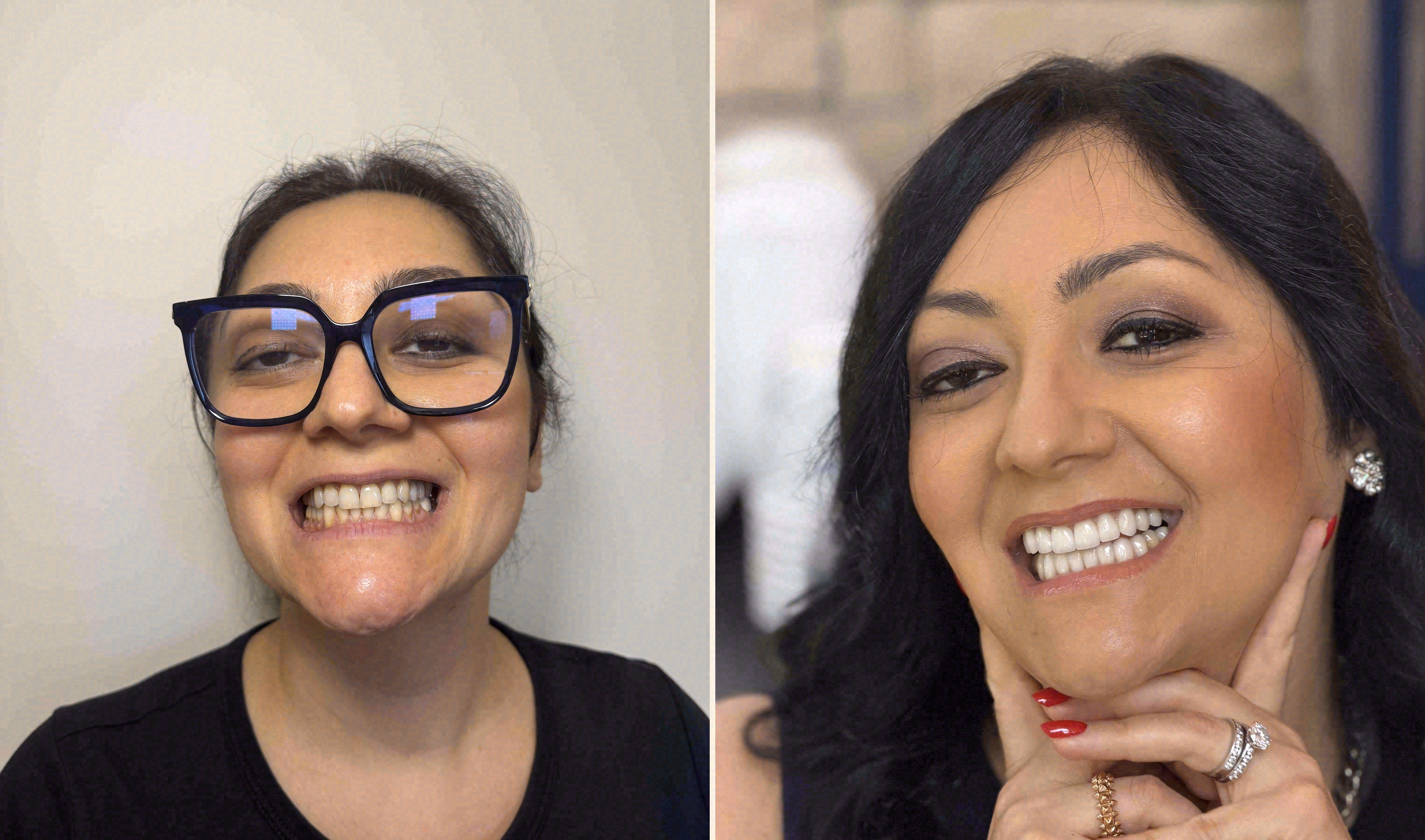Single anterior implant case, Sola Dental Spa