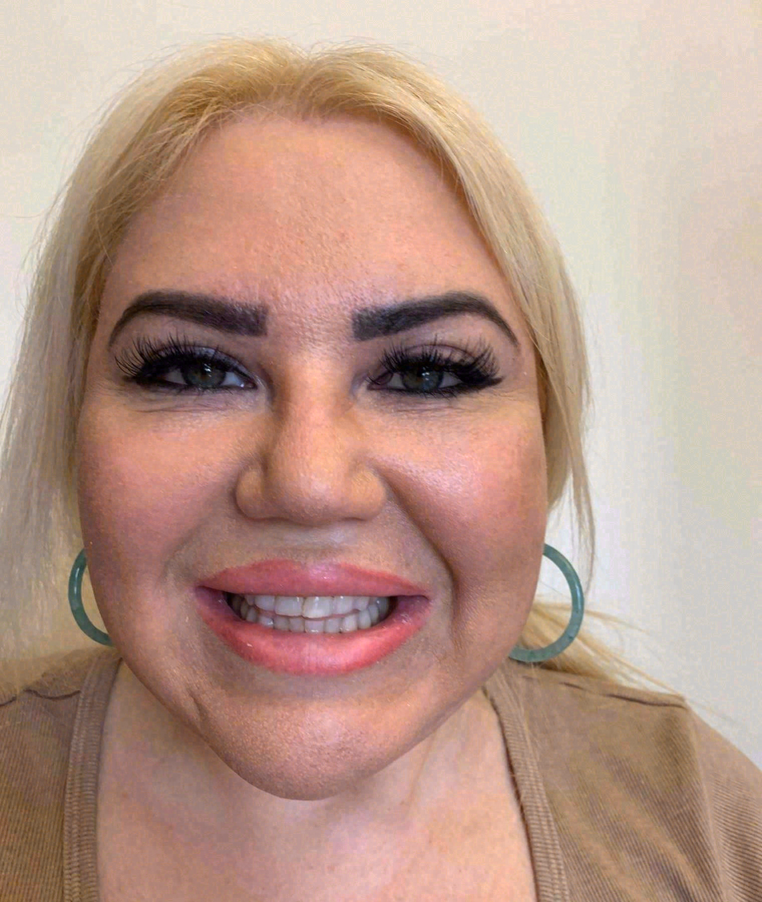Before Maya's porcelain veneers at Sola Dental Spa, Staten Island