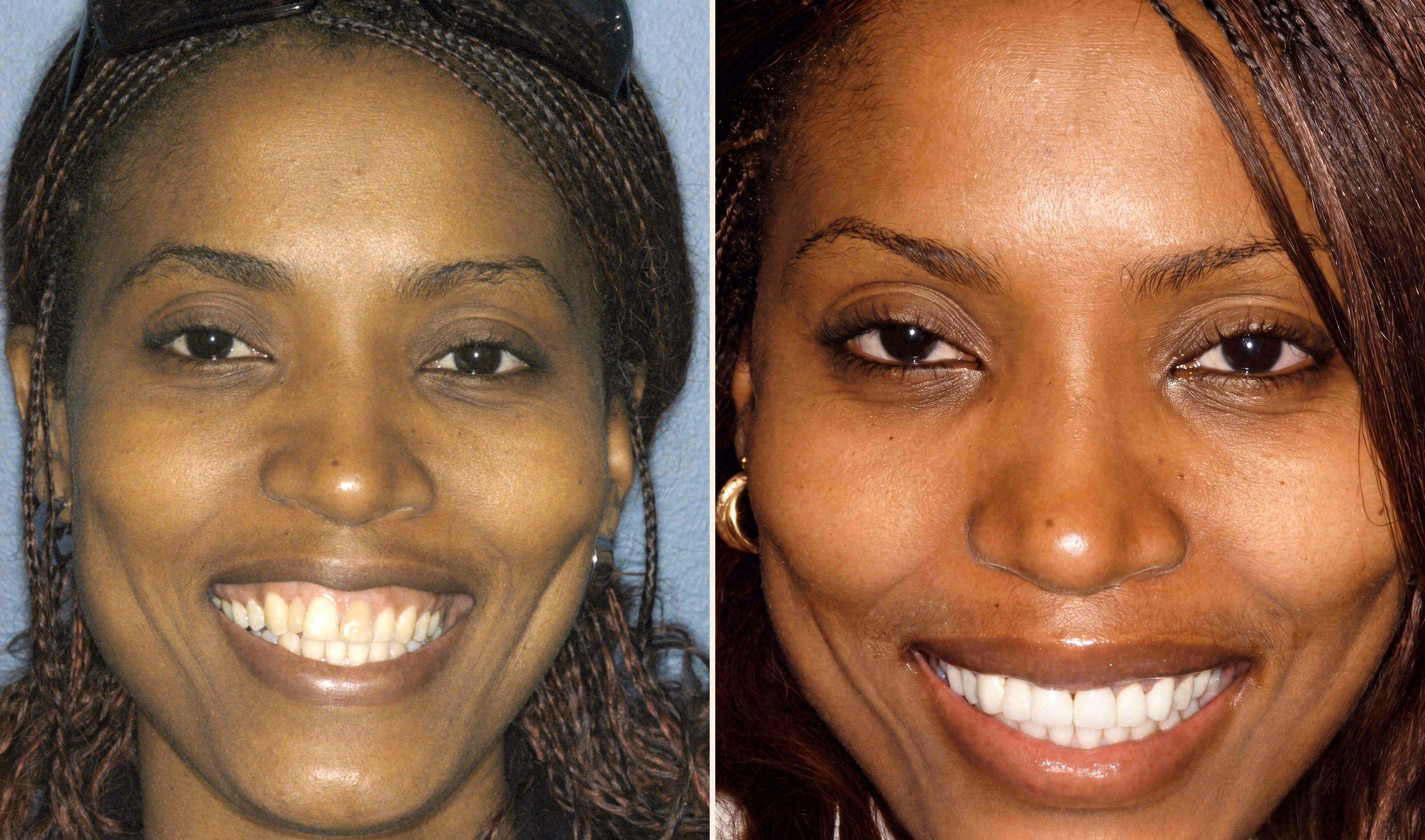 Before and after: porcelain veneers case at Sola Dental Spa