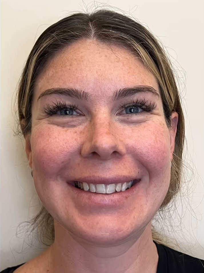 Before porcelain veneers: patient's natural smile at Sola Dental Spa, Staten Island