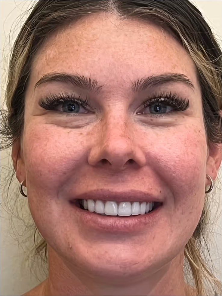 After porcelain veneers: bright, even Hollywood smile at Sola Dental Spa, Staten Island
