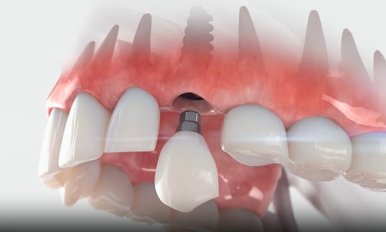 Testimonial from susan to kissimmee about dental implants