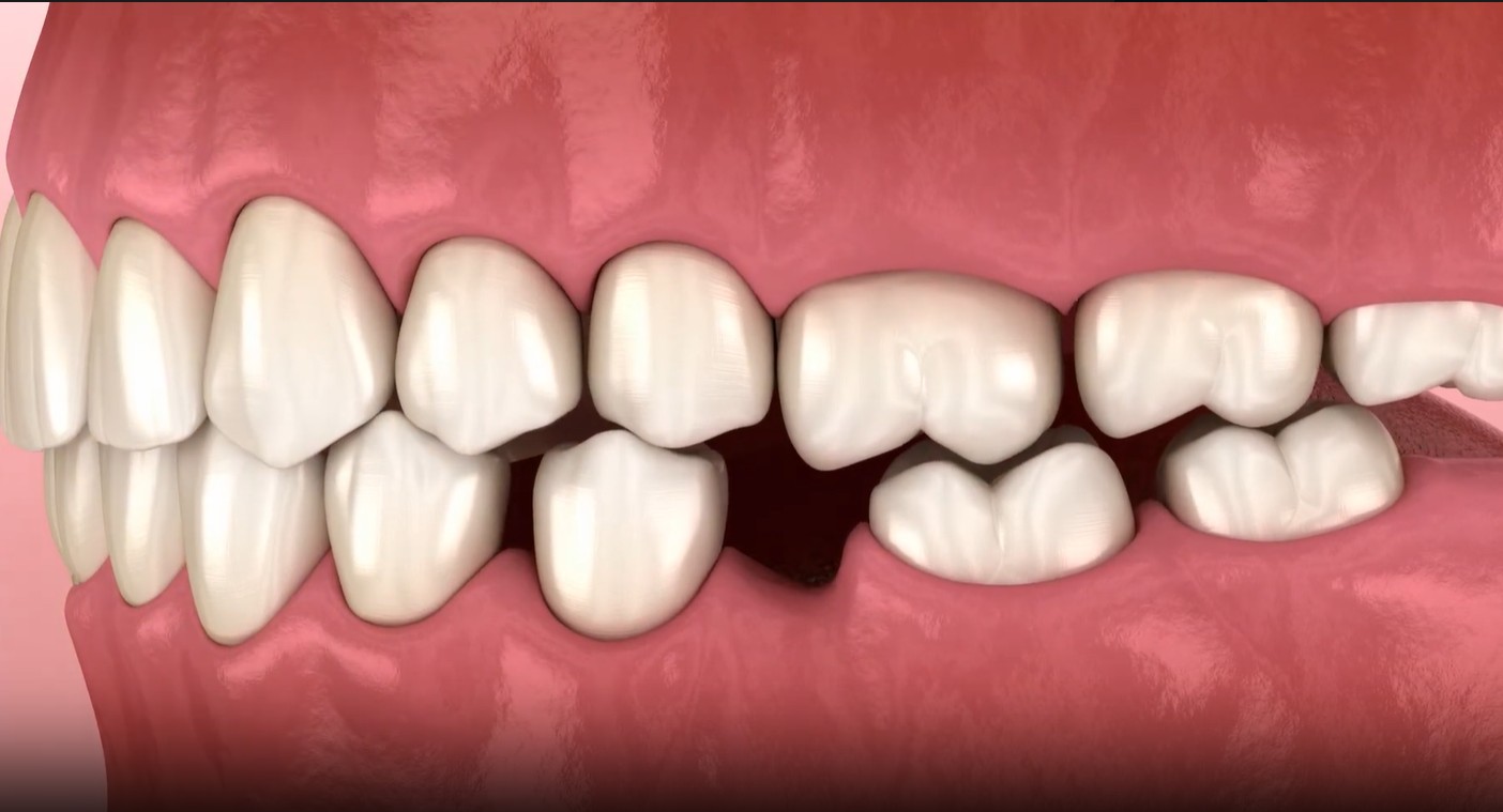 Testimonial from susan to kissimmee about dental implants