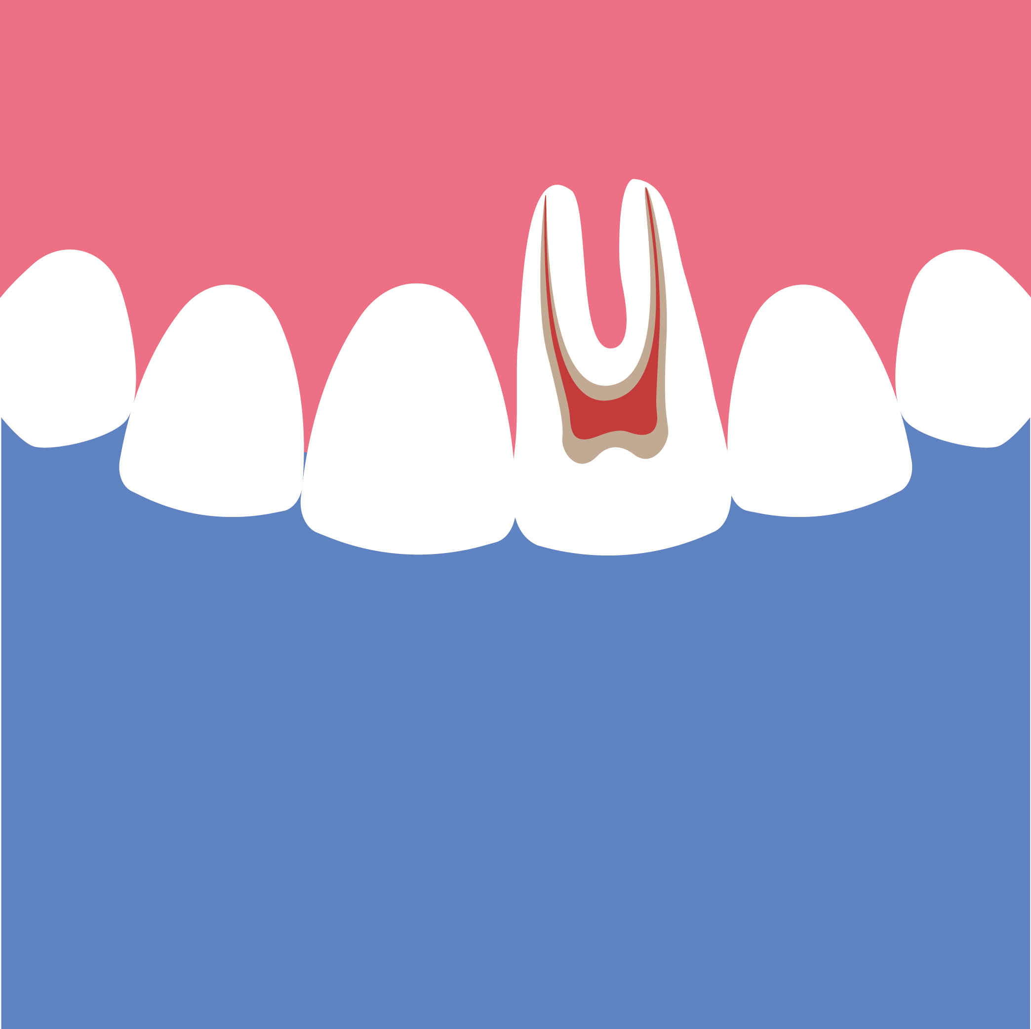 Querschnitt eines Zahns mit sichtbarer Pulpa und umgebendem Zahnfleisch.