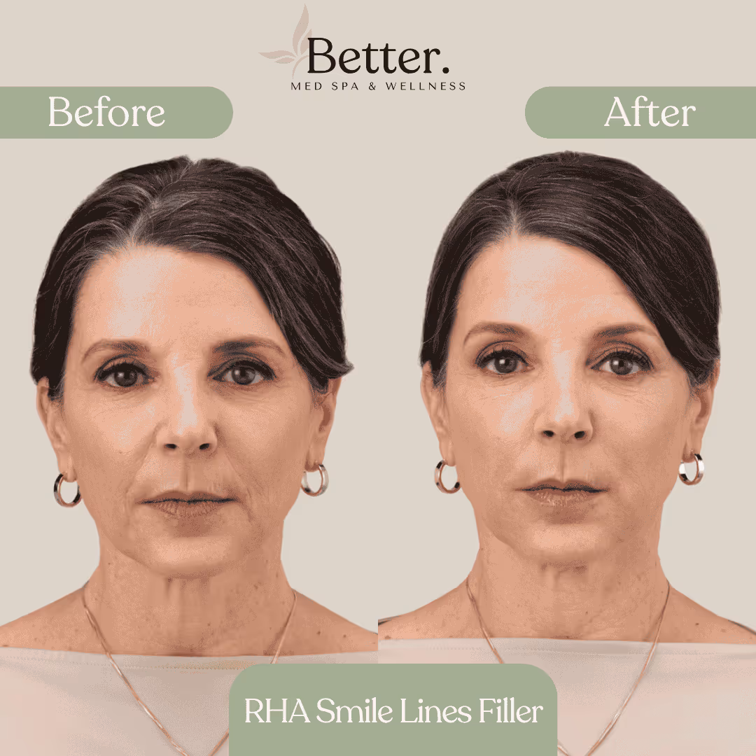 Before and after 50 units of Dysport