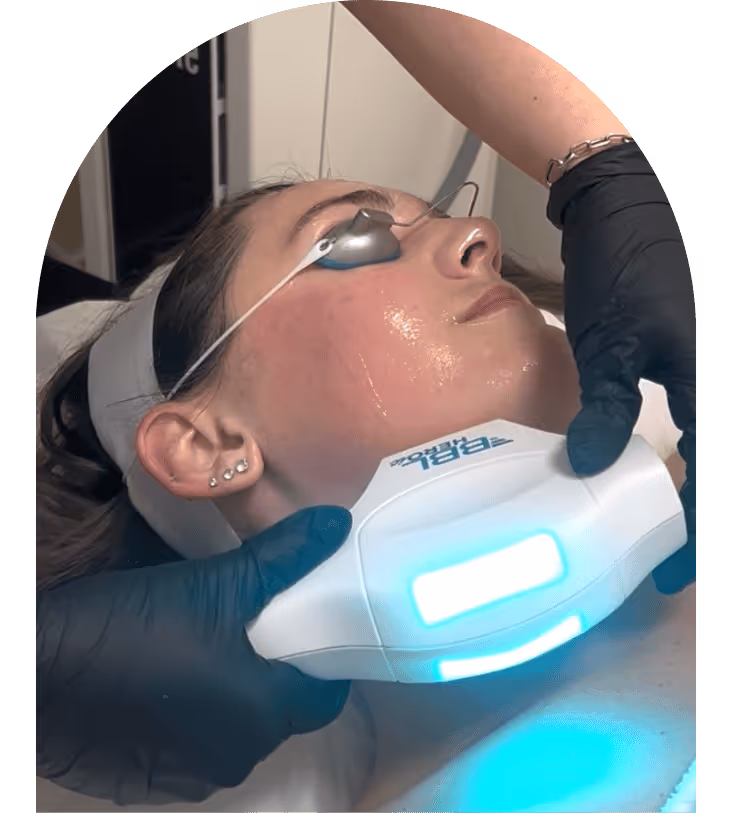 BBL photofacial treatment at Better Med Spa in Lincoln Park, Chicago