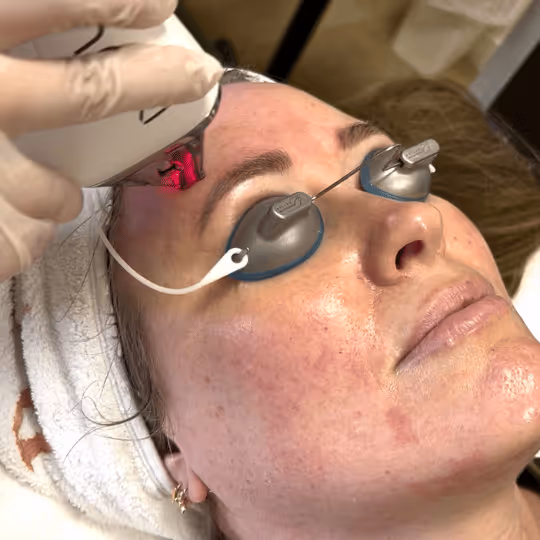 MOXI laser resurfacing treatment at Better Med Spa in Lincoln Park, Chicago