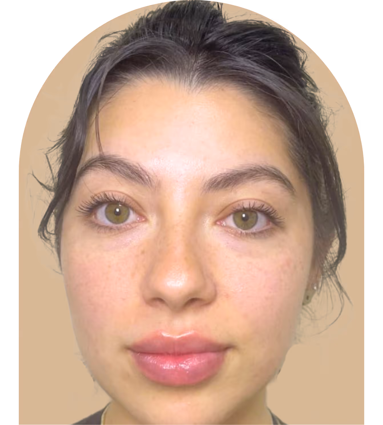 Woman with plump lips after receiving lip filler at Better Med Spa