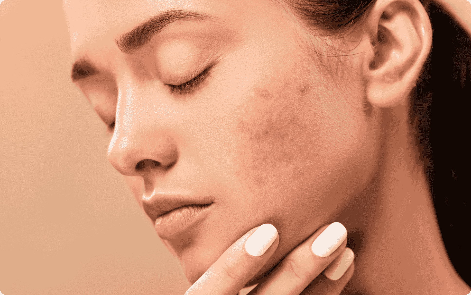 Best Non‑Invasive Rosacea Treatment in Chicago | BBL HEROic at Better Med Spa