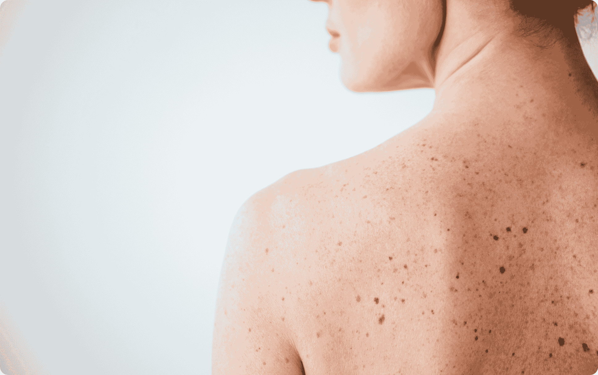 Woman with sun damage treated with BBL HEROic | Better Med Spa