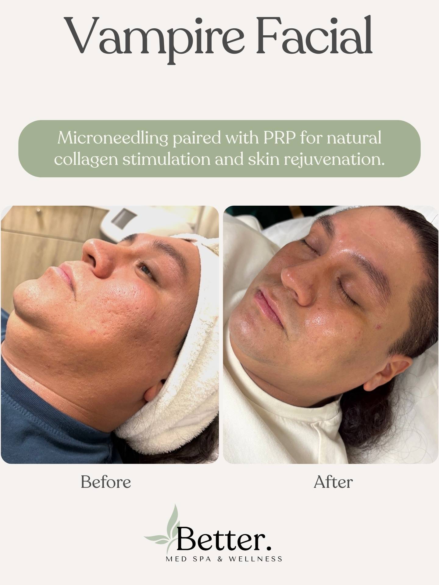 Real vampire facial before and after at Better Med Spa Chicago