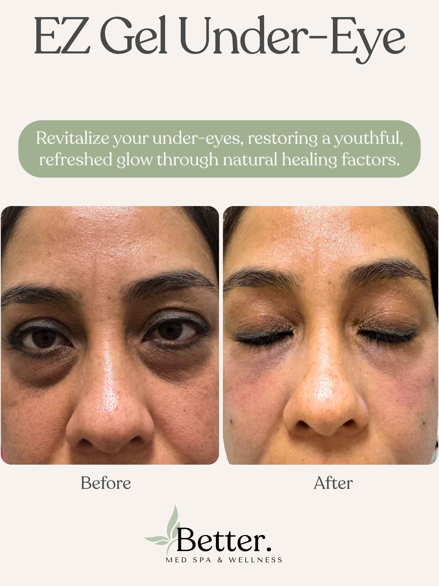 Real EZ Gel undereye results at Better Med Spa Chicago