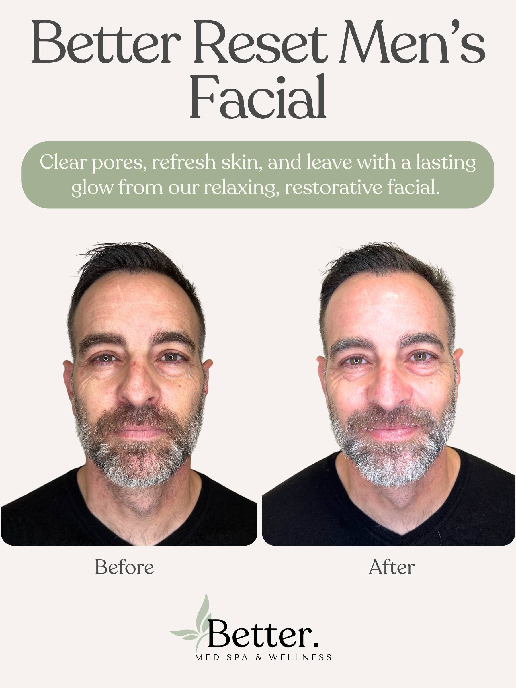 Real before and after of men's facial at Better Med Spa Chicago