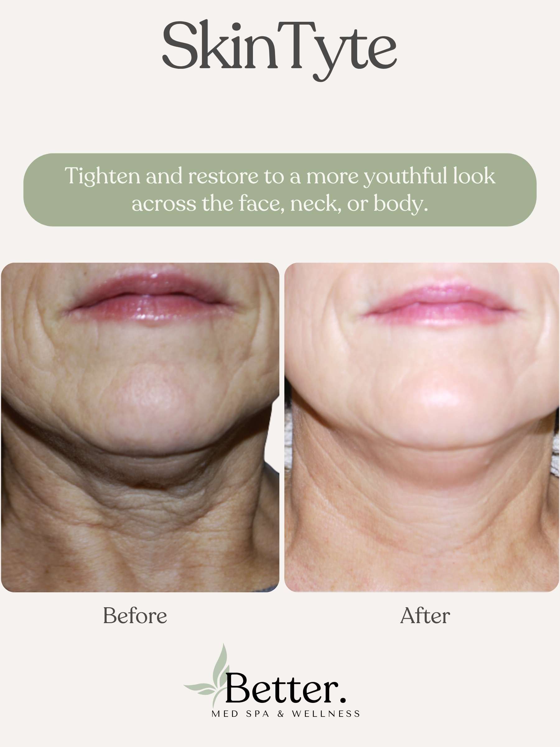 SkinTyte before and after Better Med Spa Chicago