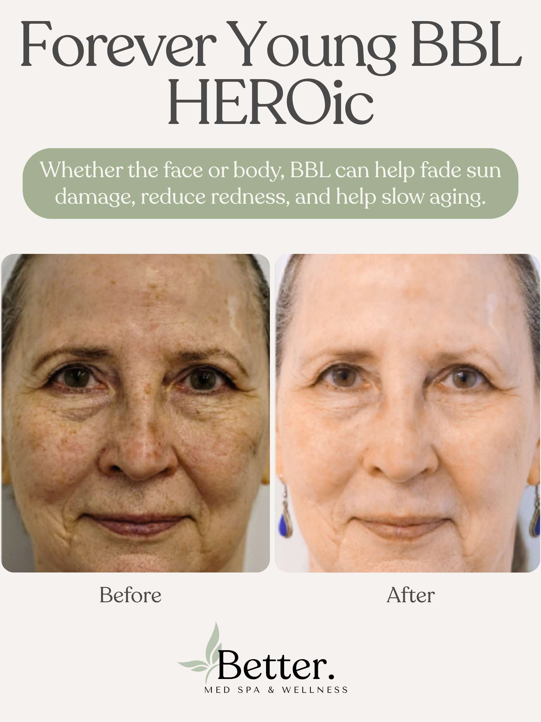 Broadband light before and after Better Med Spa