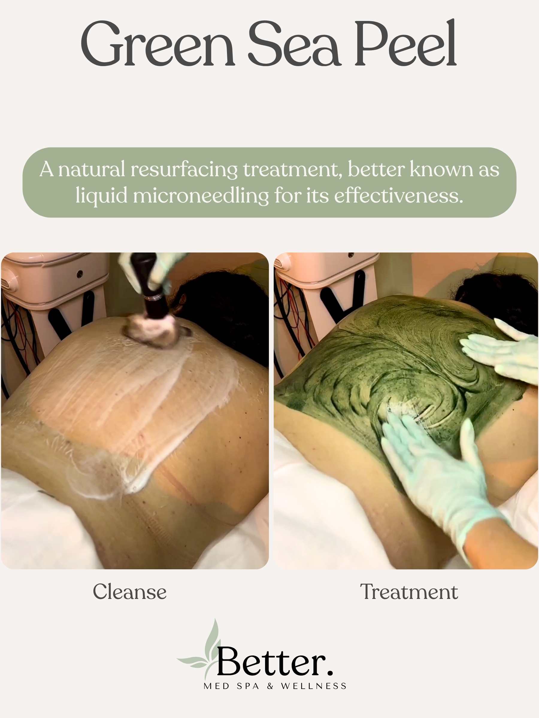 Real green sea peel at Better Med Spa Chicago