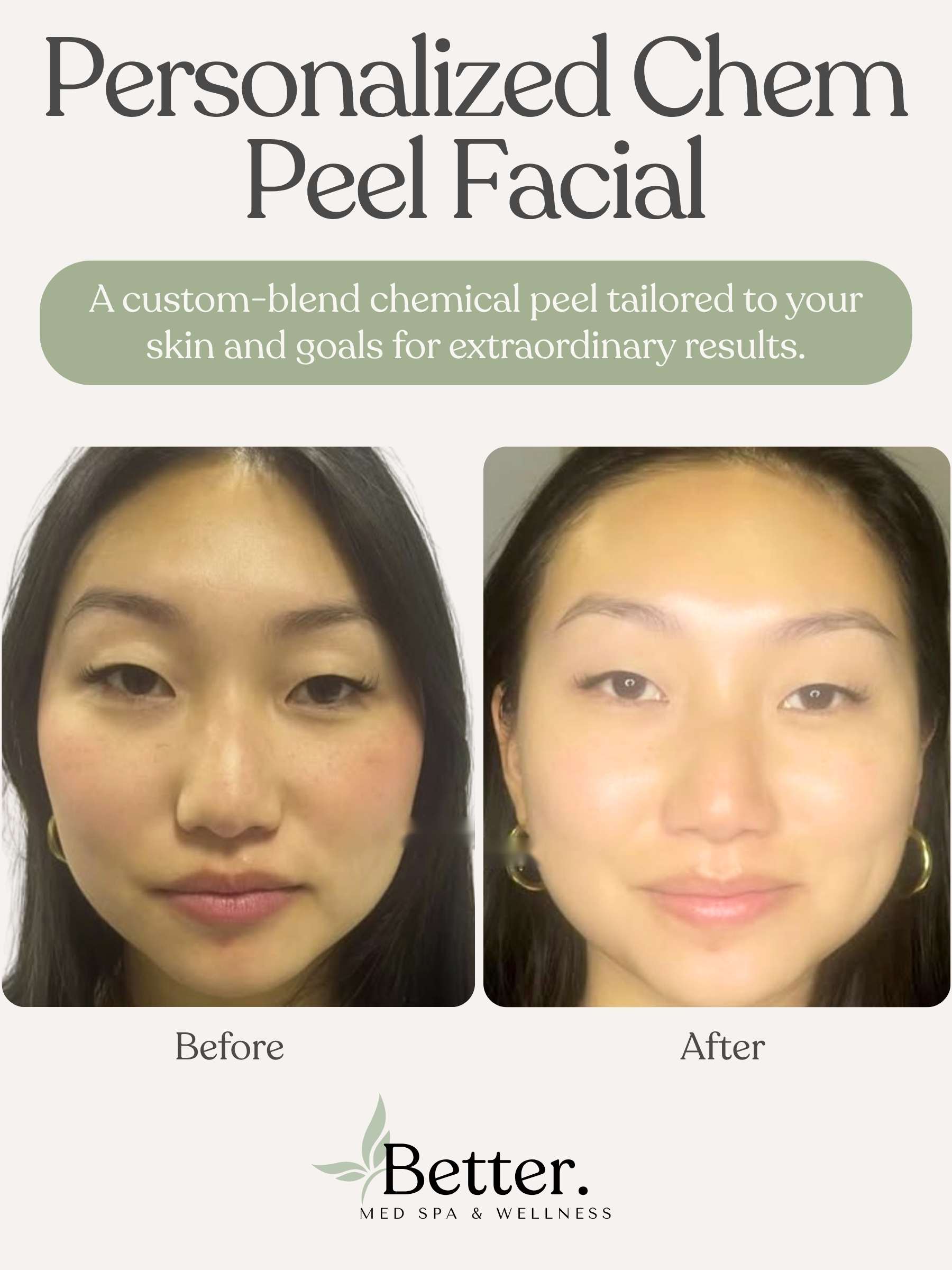 Real before and after chem peel at Better Med Spa Chicago