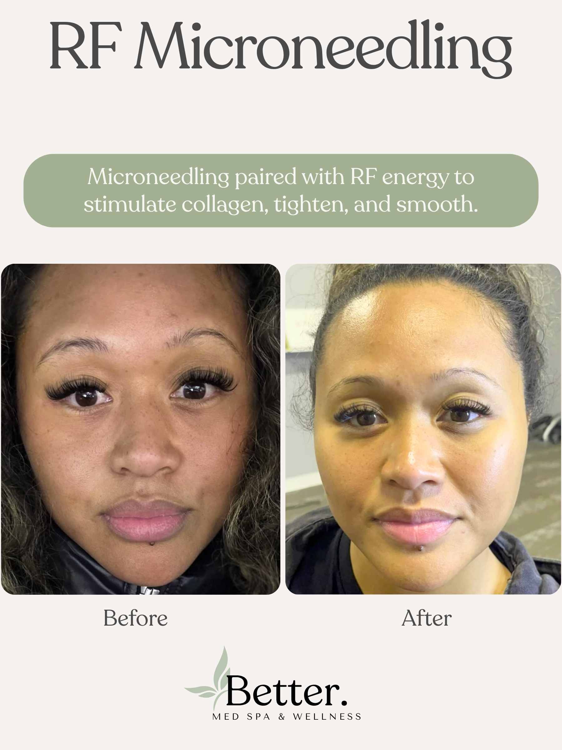 RF Microneedling real before and after Better Med Spa Chicago