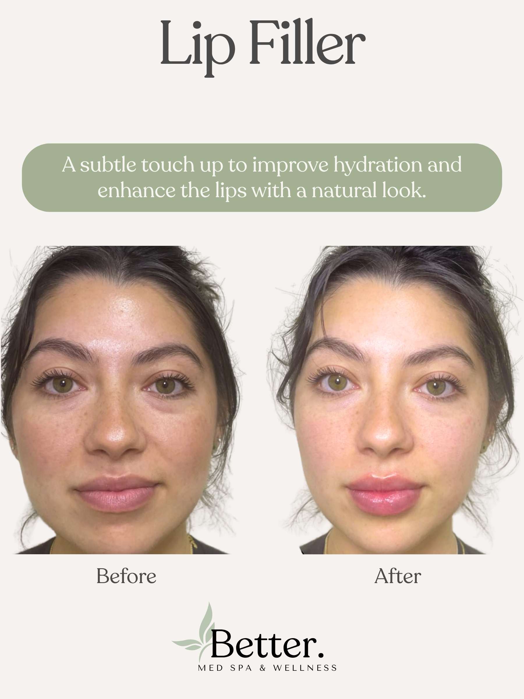 Lip Filler real before and after Better Med Spa Chicago
