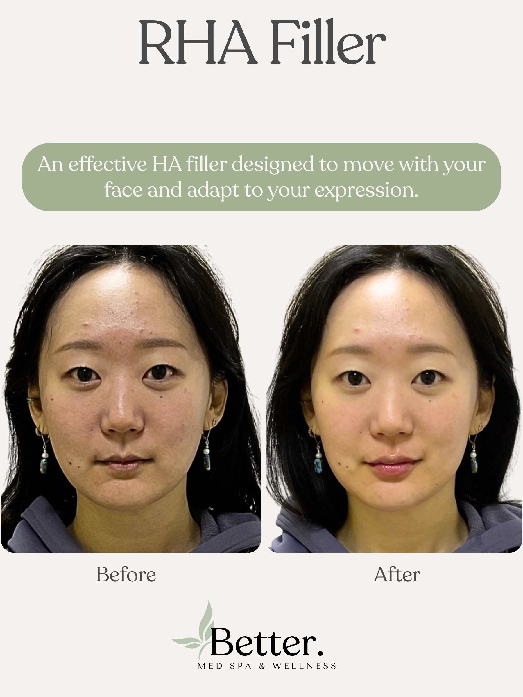 Real RHA filler before and after Better Med Spa Chicago