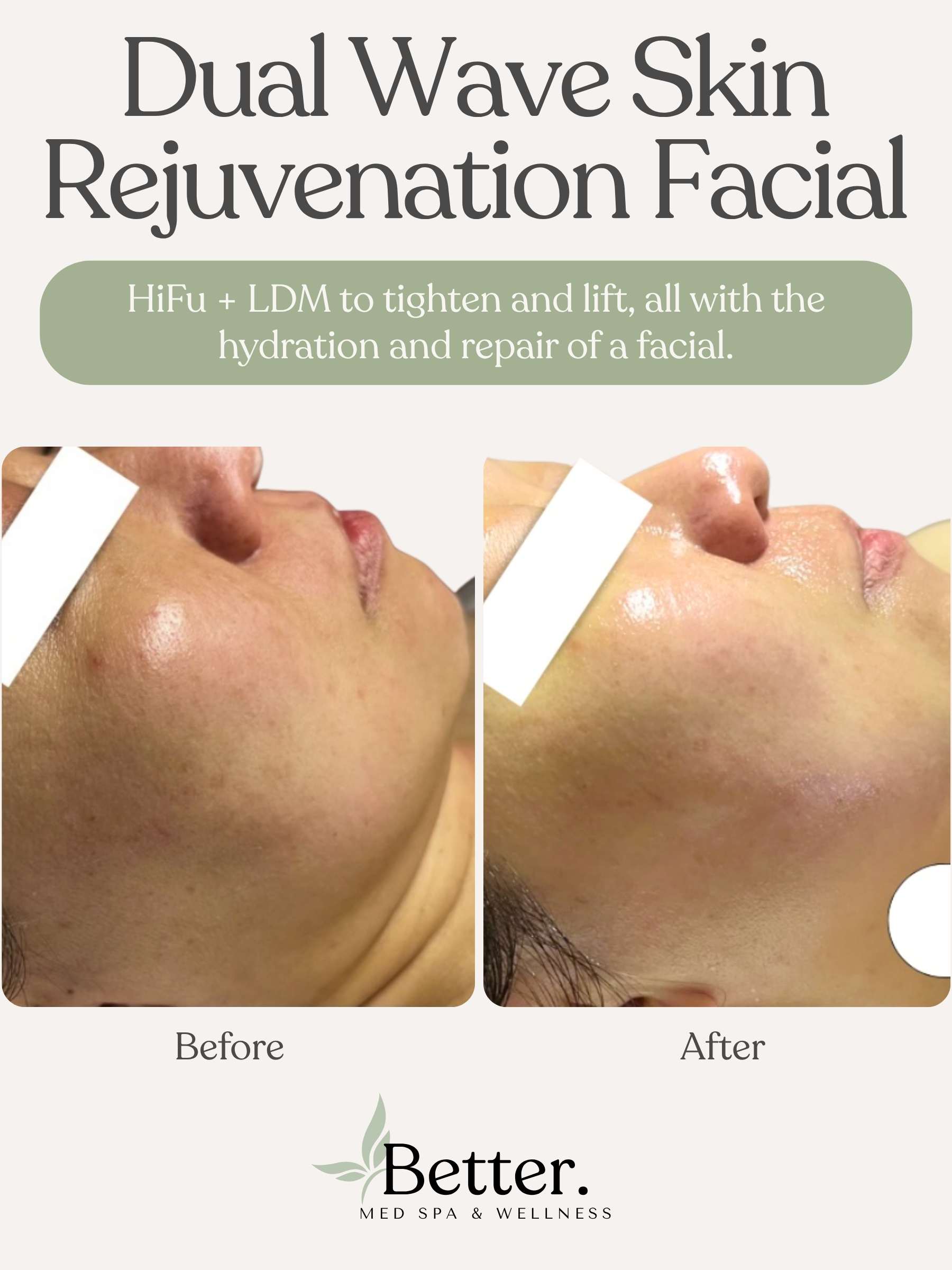 Real dual wave before and after Better Med Spa Chicago