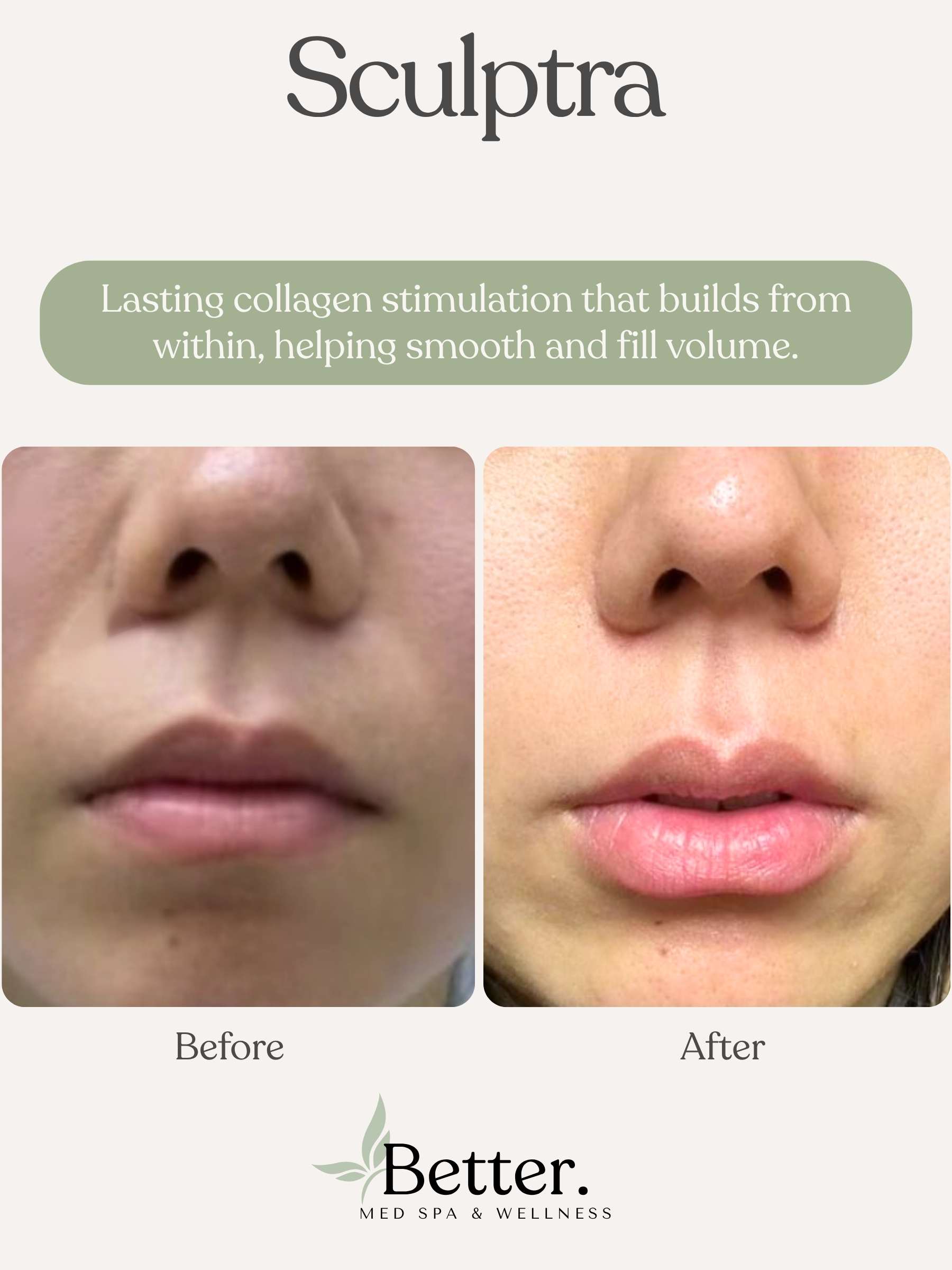 Real Sculptra before and after Better Med Spa Chicago