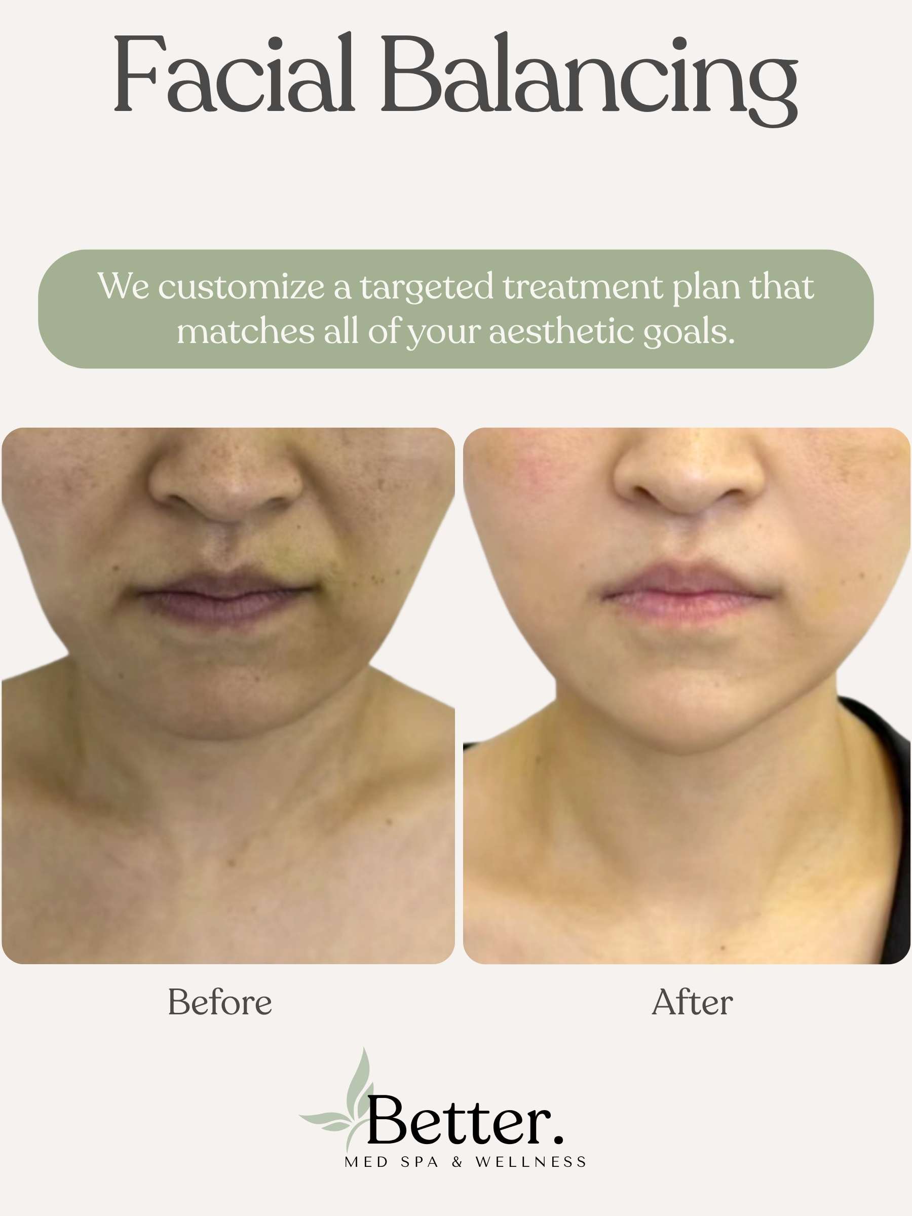 Facial balancing real before and after Better Med Spa Chicago