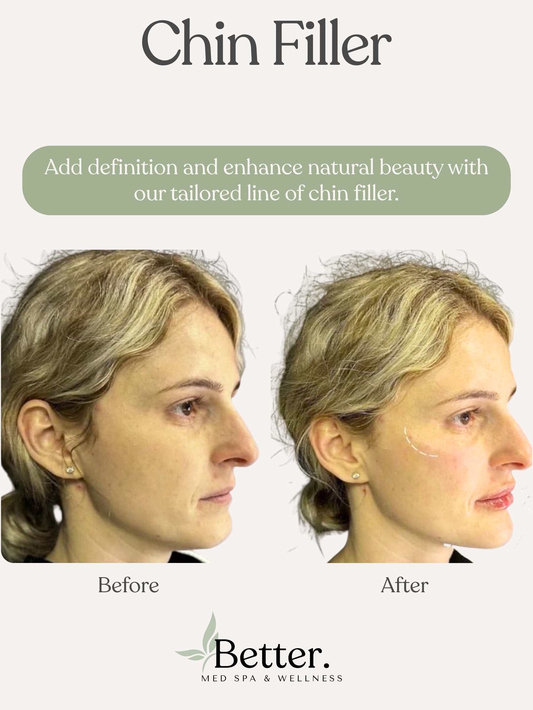 Real chin filler before and after Better Med Spa Chicago