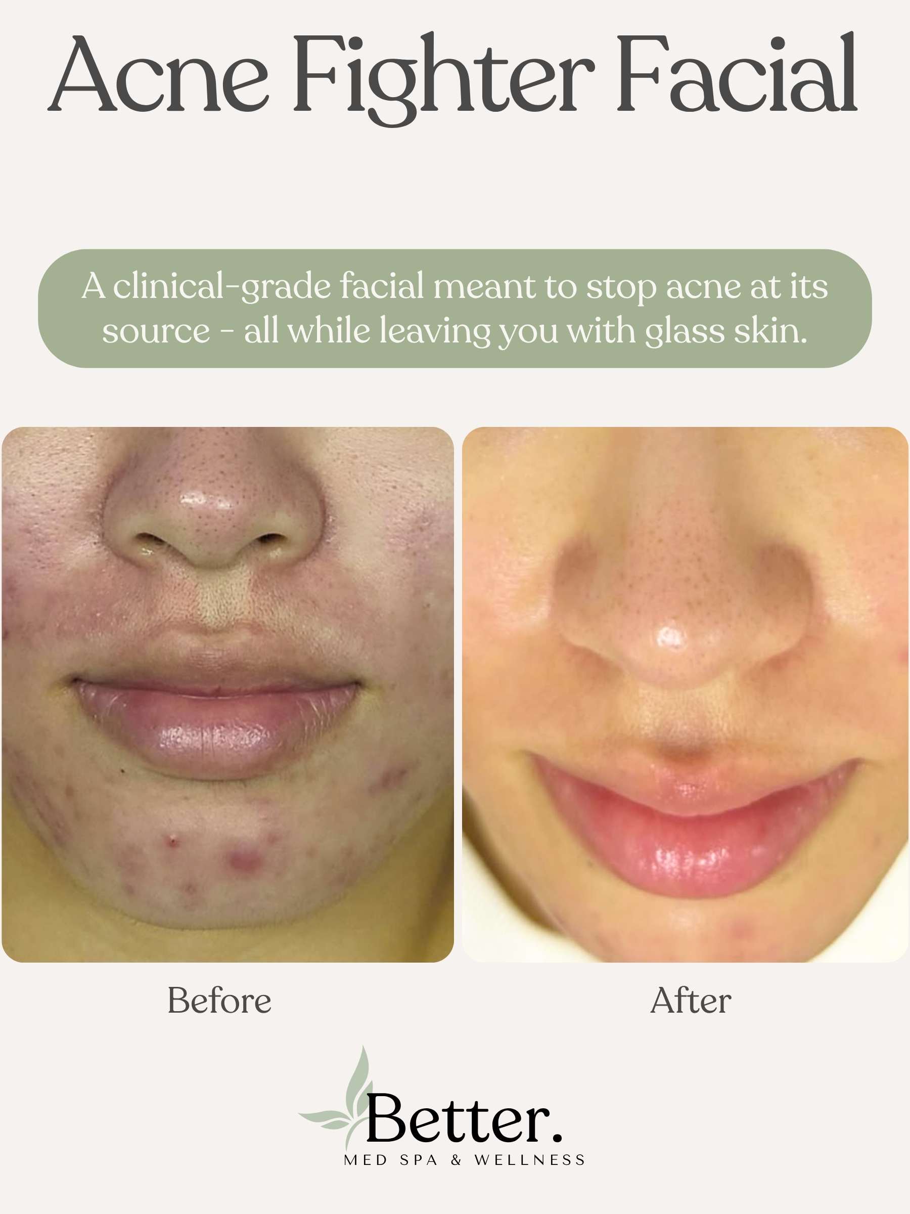 Real acne facial before and after Better Med Spa Chicago