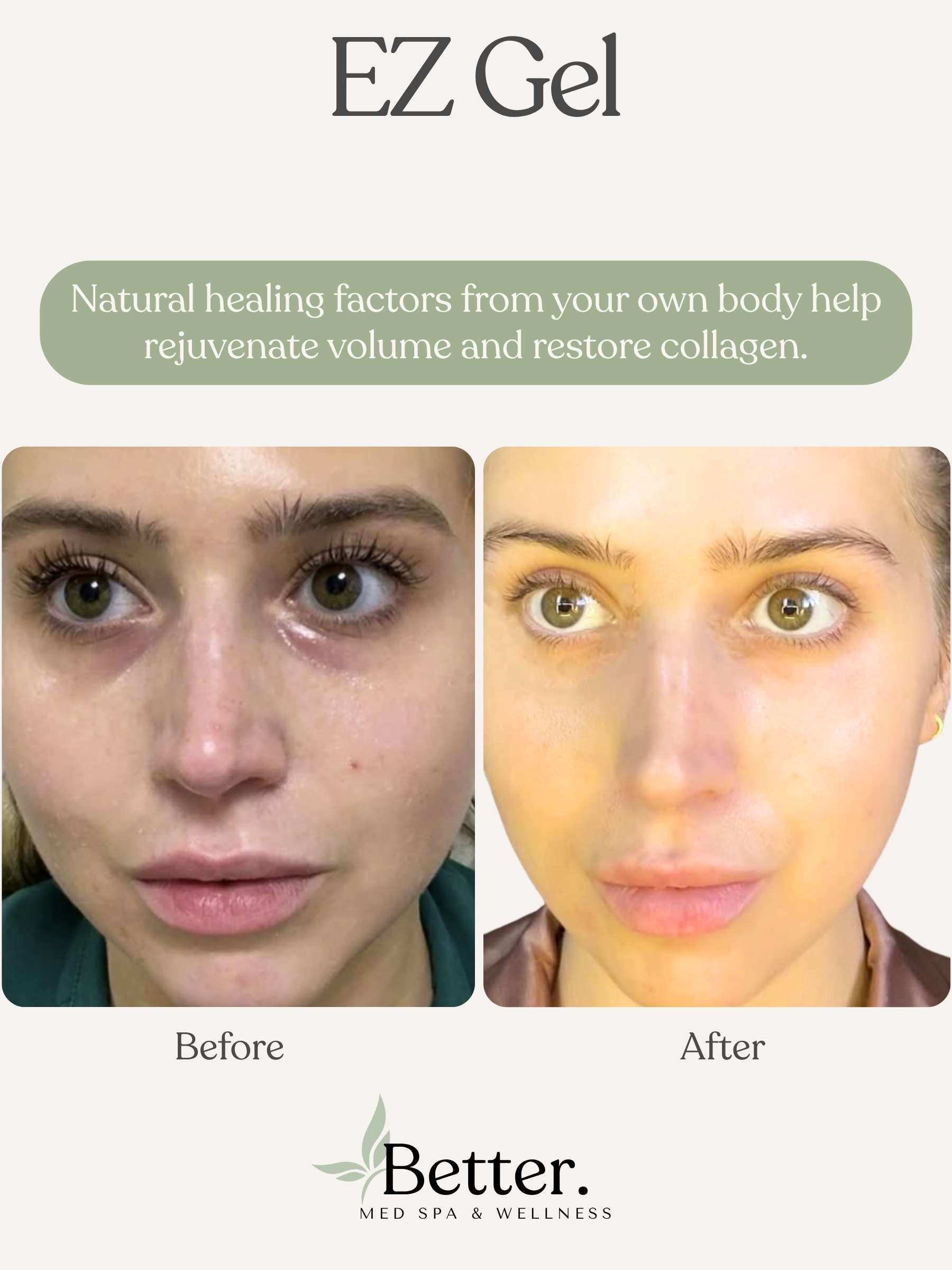 EZ Gel real before and after Better Med Spa Chicago