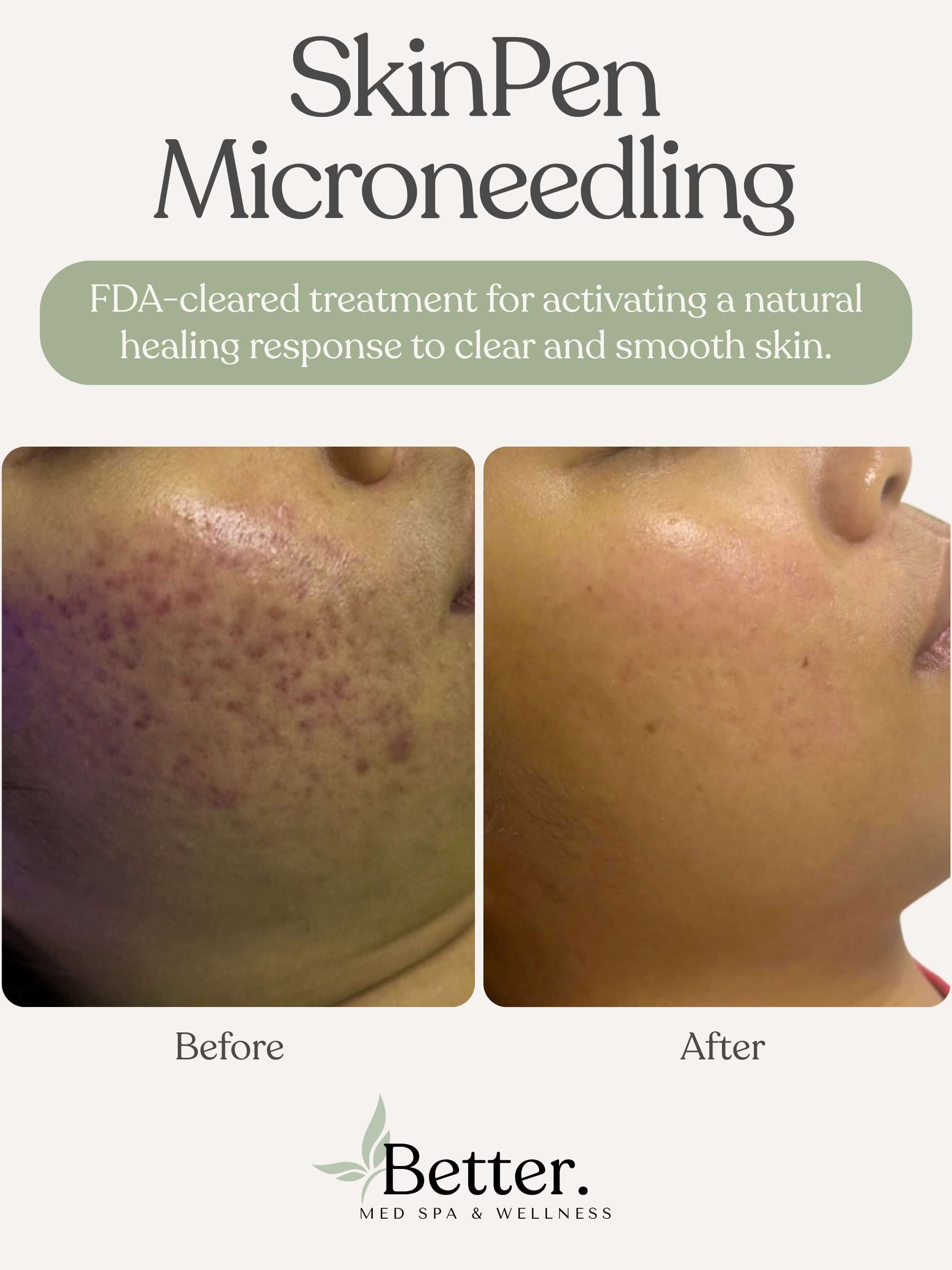 Real SkinPen Microneedling before and after at Better Med Spa Chicago