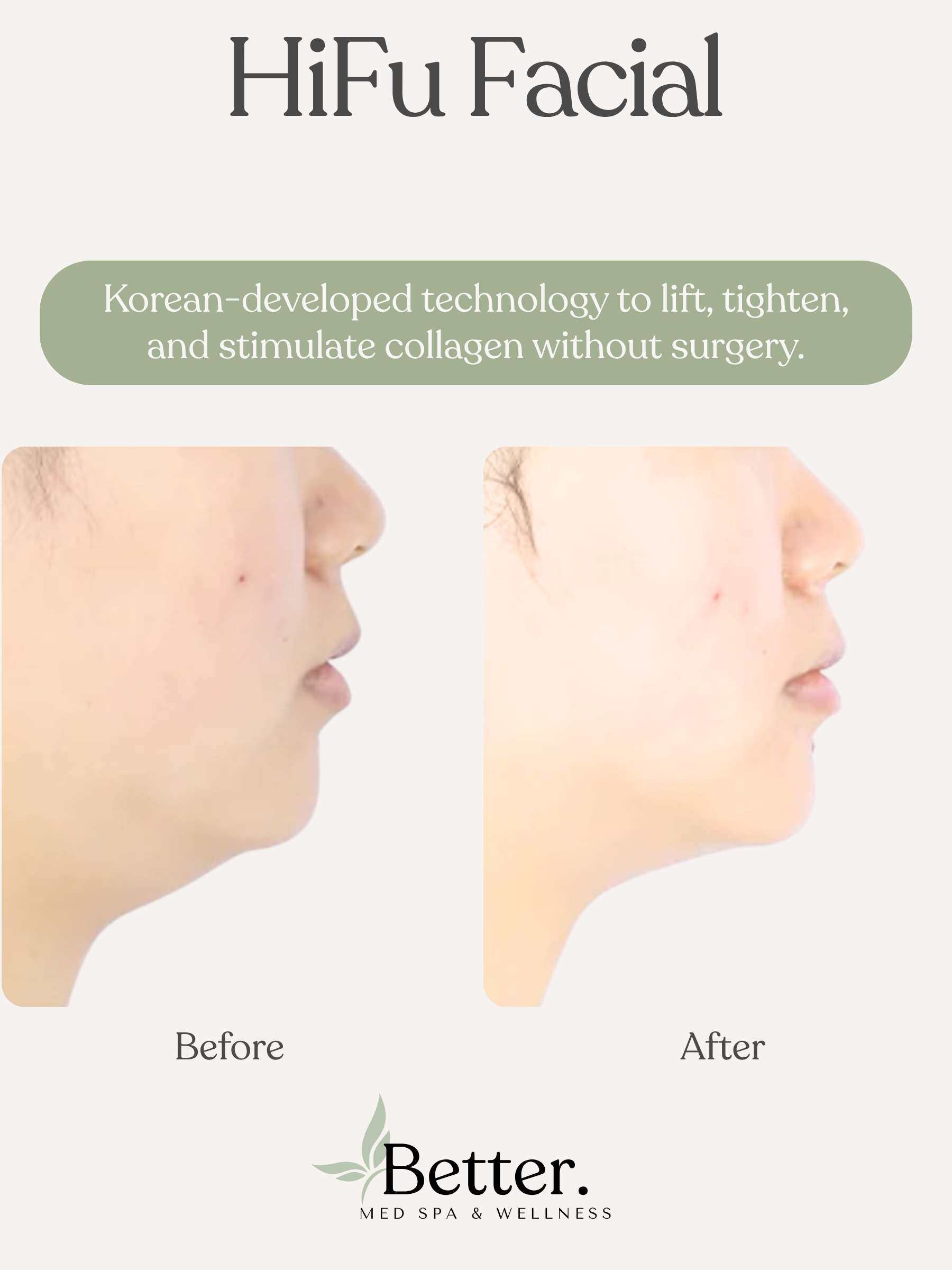 HiFu before and after double chin Better Med Spa Chicago