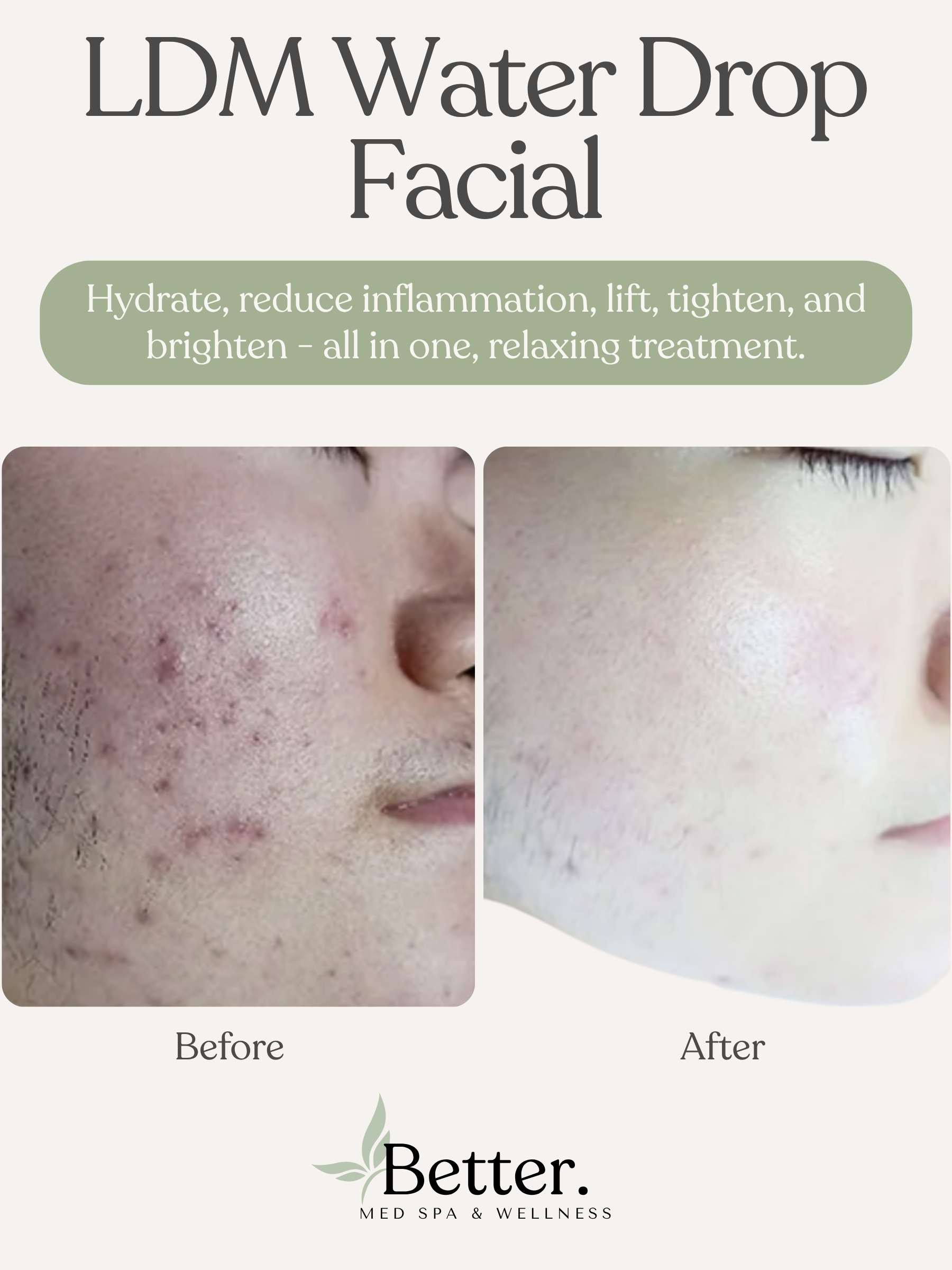 LDM HiFu clearing effects Better Med Spa Chicago