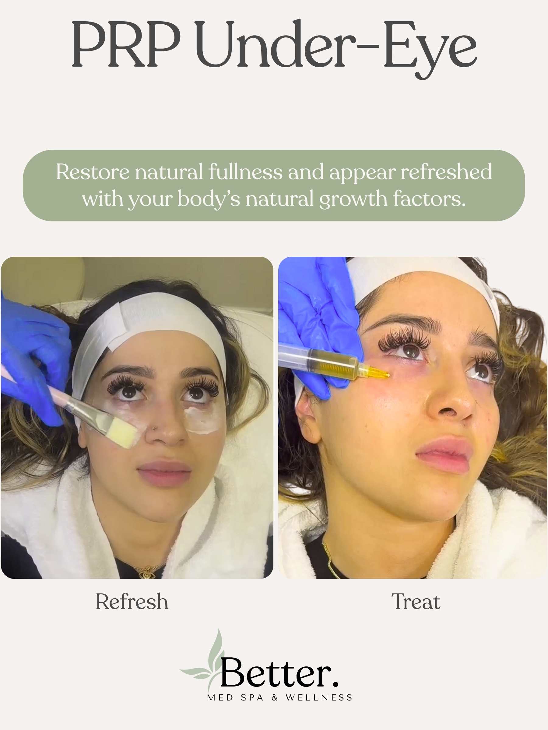 Real PRP Undereye treatment at Better Med Spa Chicago