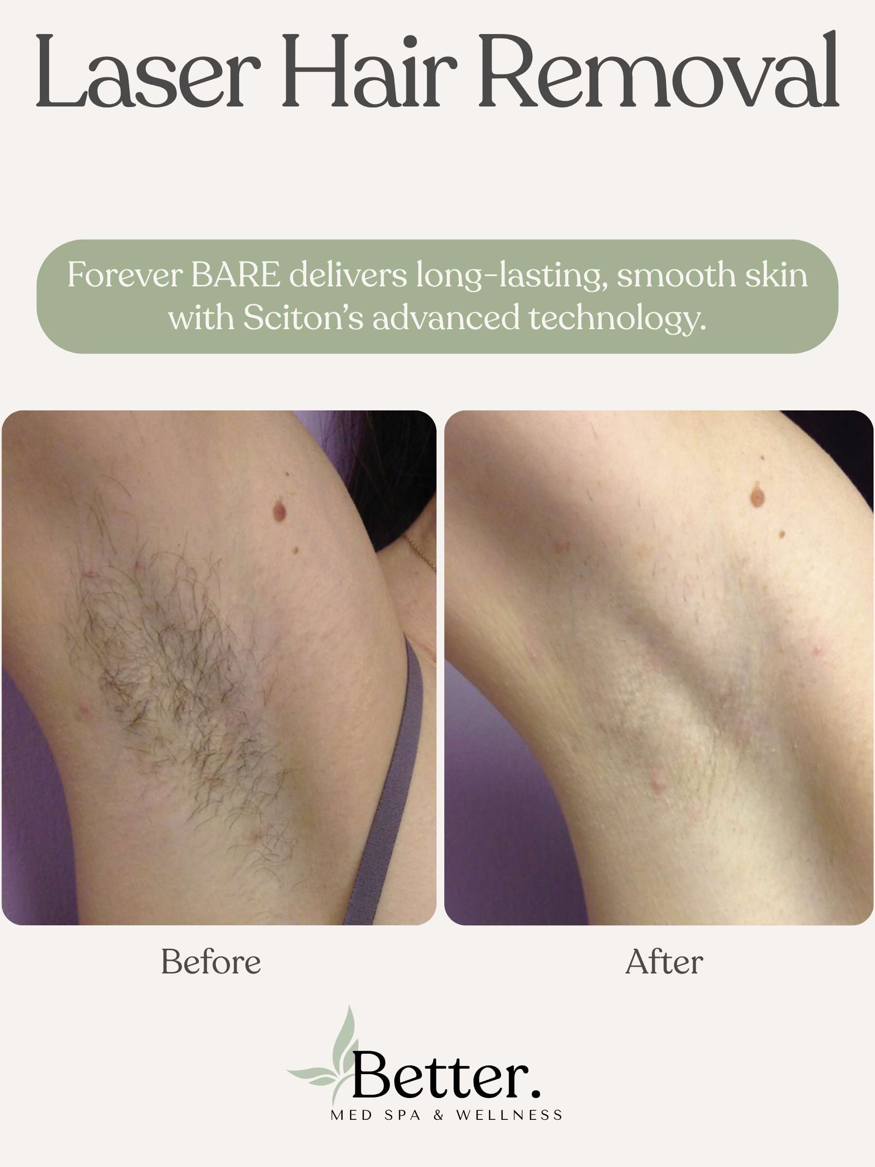 Sciton BBL laser hair removal Better Med Spa Chicago