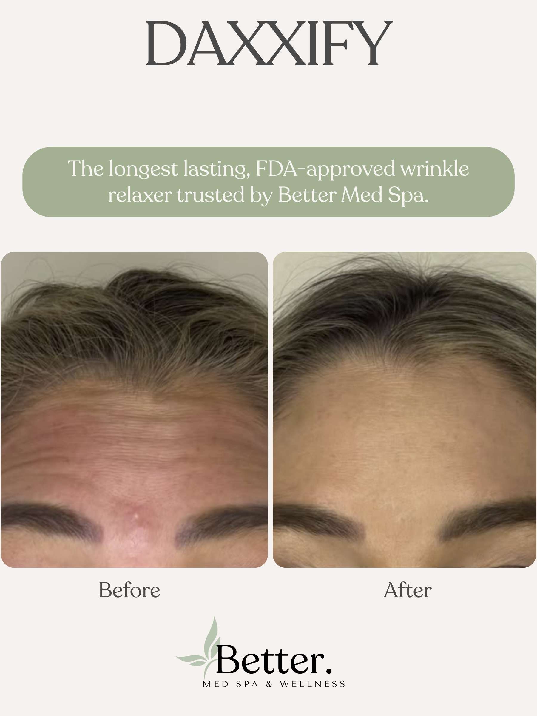 Real DAXXIFY before and after at Better Med Spa Chicago