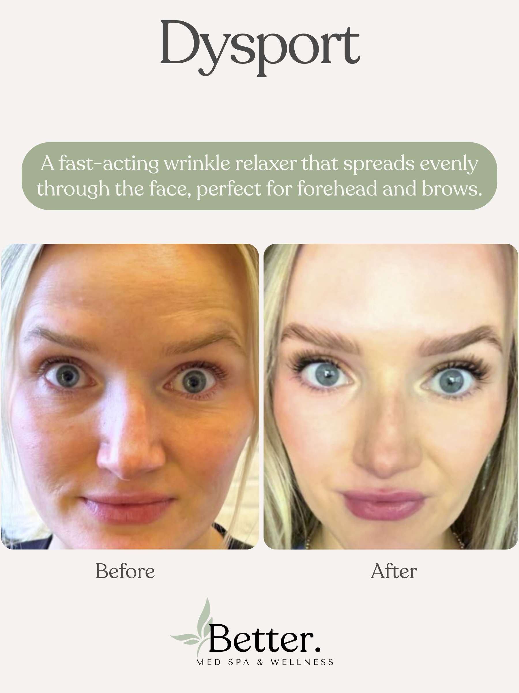 Real dysport before and after Better Med Spa Chicago