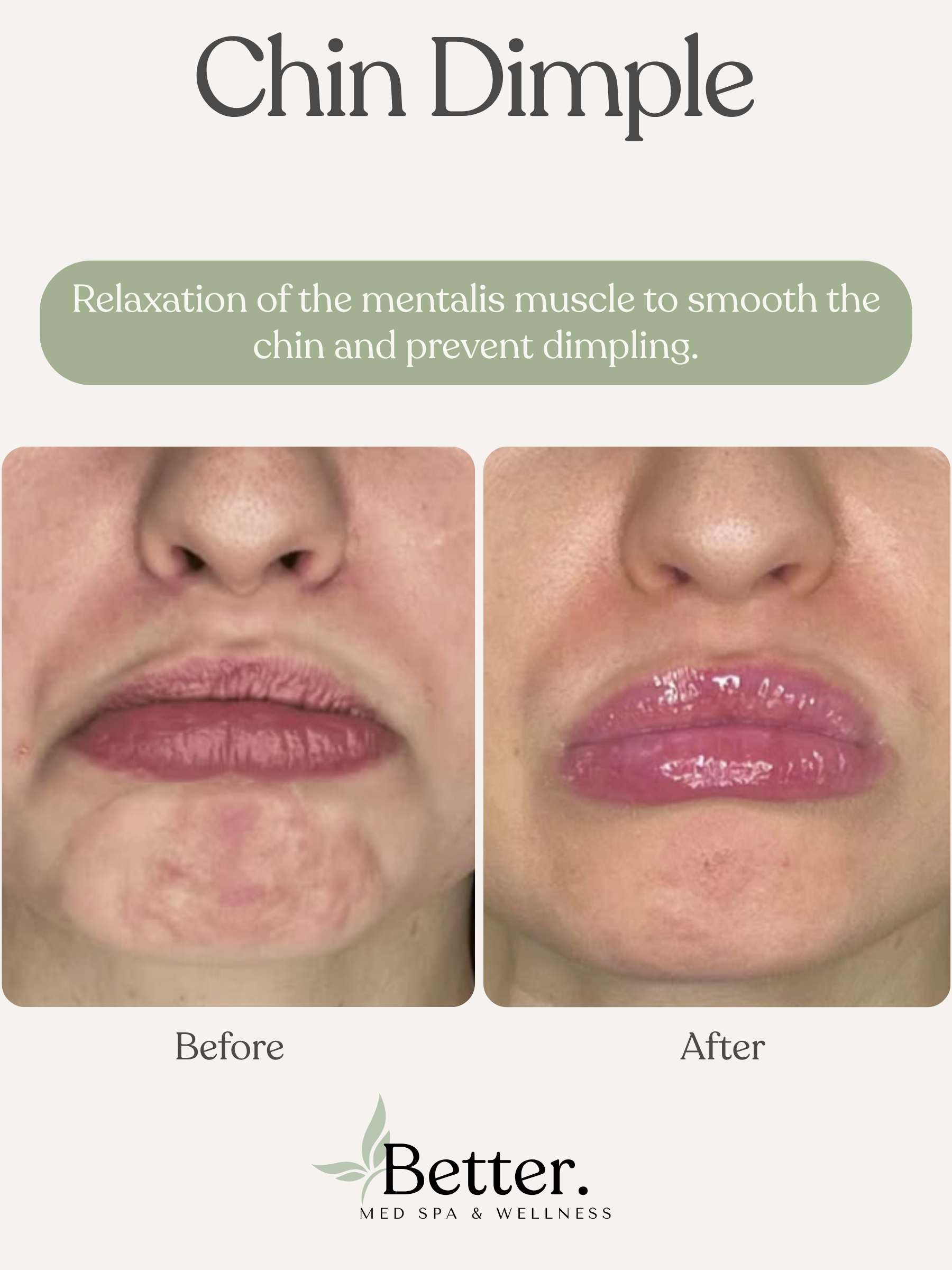 Chin dimple treatment real before and after Better Med Spa Chicago