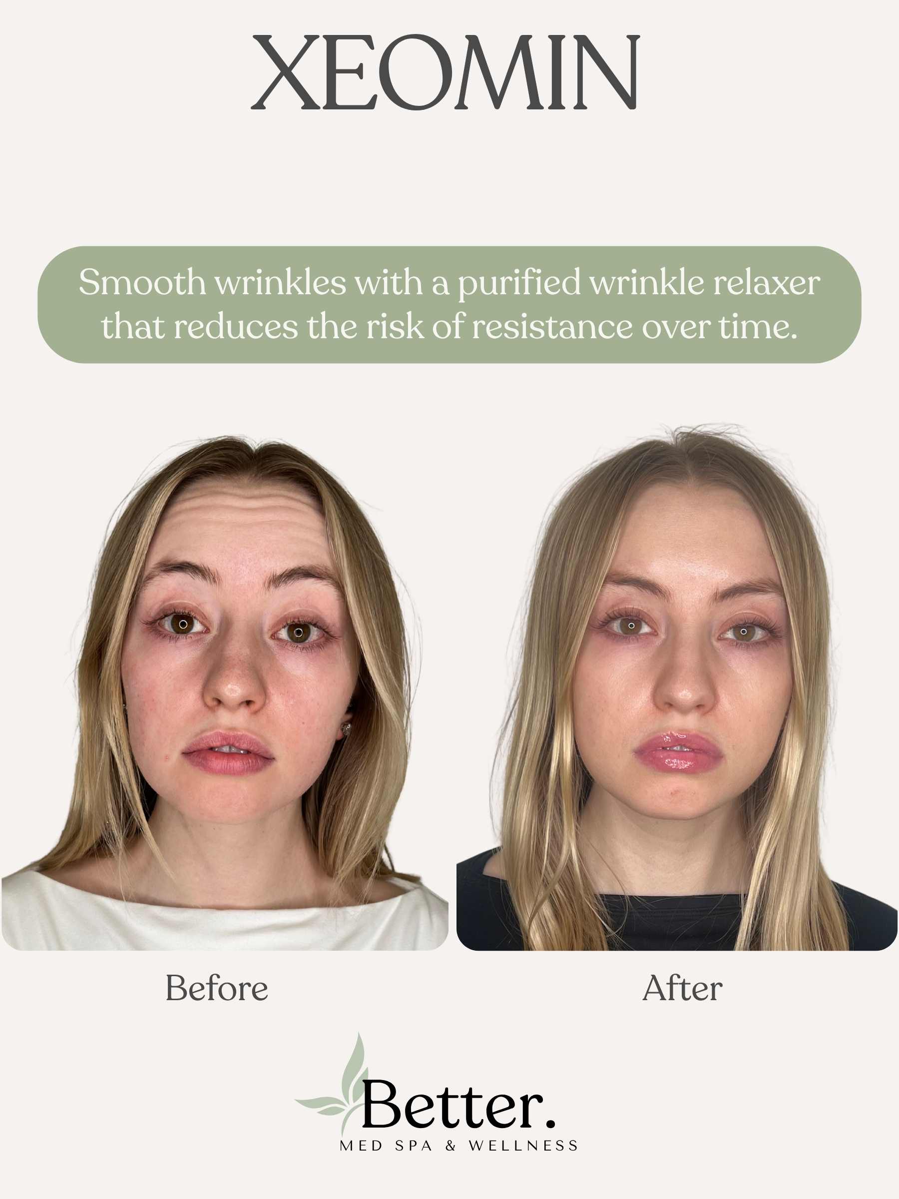 Real XEOMIN before and after at Better Med Spa Chicago