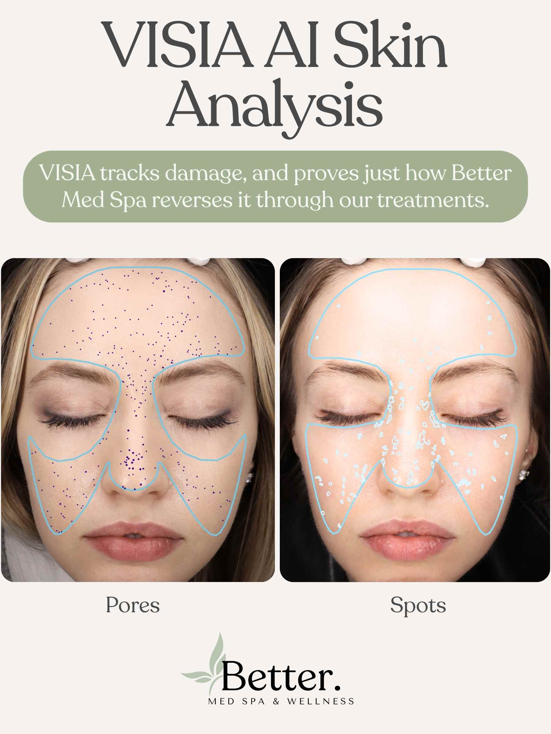 VISIA AI Skin Analysis before and after Better Med Spa Chicago