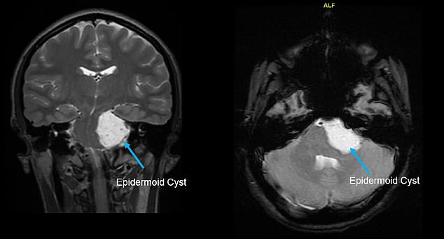 After one particularly bad sore throat, she went to the ER, where doctors performed a CT scan of her throat and head. Pictured, left and right: Scans of Giuffrida's cyst