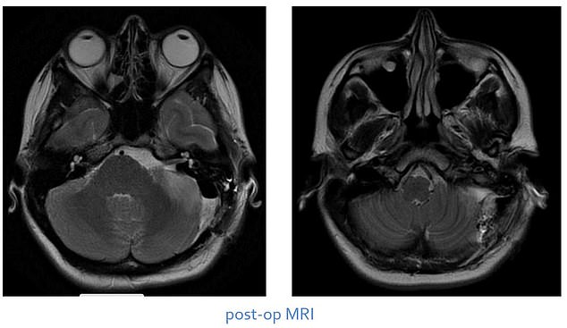 Giuffrida's swallowing and hearing improved, but she needed about a week of rehabilitation for her balance. Pictured: Scans of Giuffrida's brain after the operation