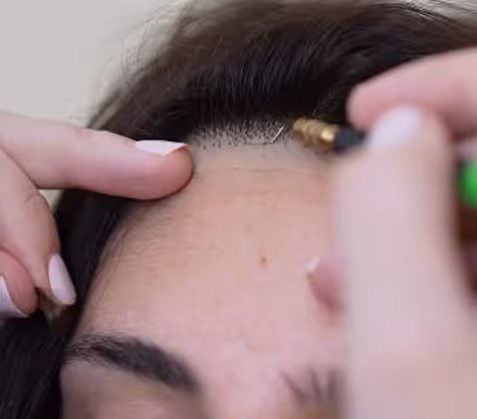 Person recevant un traitement de micropigmentation sur la racine des cheveux pour imiter la pousse des cheveux.
